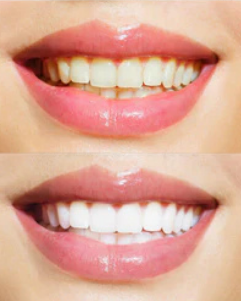Teeth Whitening